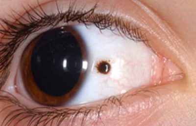 Пігментну пляму в оці. Профілактика ракової трансформації невусів очей. Значення родимок в області очей