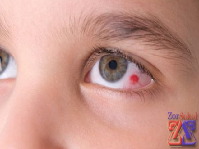 Кров в очному яблуці що робити. Які краплі використовують при крововиливі в око.