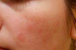 Алергія у дитини почервоніння на руках. Освіта алергічних плям на тілі, їх різновиди та причини