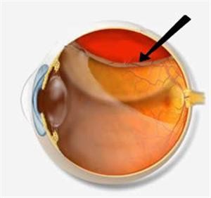 Очні краплі при крововиливі. Симптоми крововиливу в сітківку. Відео-передача про синдром червоних очей.