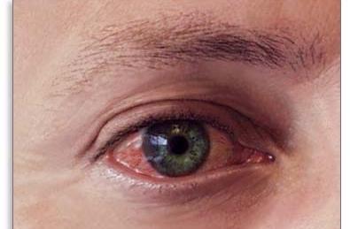 Як лікувати запалені очі у дорослої людини. Симптоми і діагностика. Дієві лікувальні процедури