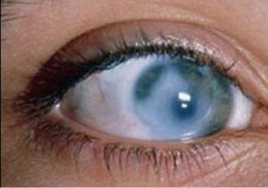 Хвороби століття очей у людини. Хвороби очей у людини