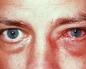 Чому болять очі і що викликає такий симптом