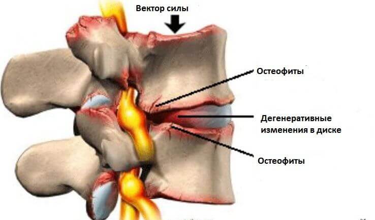 Код МКБ шийно грудний остеохондроз. Лікування запущених форм остеохондрозу. Недуга і його підвиди