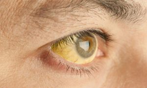 Чому очі жовтуваті. Інші причини появи жовтого відтінку склери. Причина жовтизни очей - захворювання печінки