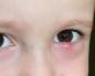 Блефарит у дітей: симптоми і лікування, причини, фото
