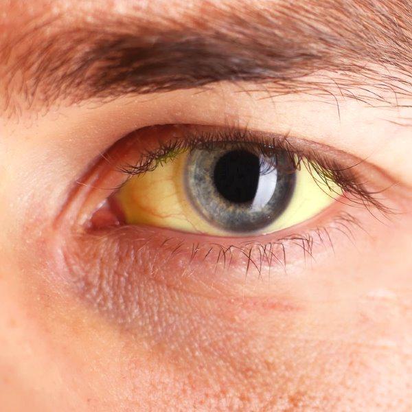 Жовтуваті очі по краях. Причини жовтих білків очей у дорослих і дітей