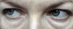 Набряки очей вранці. Які хвороби можуть викликати набряки? Коли потрібно терміново звернутися до лікаря