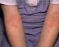 Атопічний дерматит у дітей: лікування, причини, симптоми, препарати Атопічний дерматит у дітей 7 років лікування