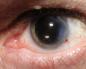 Причини, симптоми, методи лікування вродженої та інших видів катаракти у дітей Стареча катаракта код по МКБ 10
