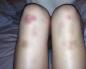 Від чого у жінок з'являються синці на ногах без ударів: причини та лікування Невеликі синці на ногах