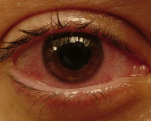 این چیست - uveitis؟ یووییت چشم یک بیماری پیچیده و خطرناک است.