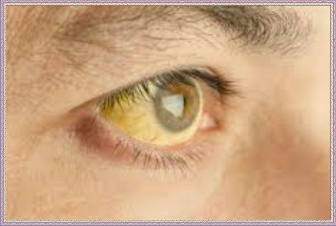 Žlté škvrny pod očami. Žltosť pod očami: príčiny a charakteristiky liečby. Kruhy pod očami, čo robiť