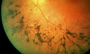 Periferna horioretinalna distrofija mrežnice: vrste, tretman pch. Periferna retinalna distrofija pvhrd.