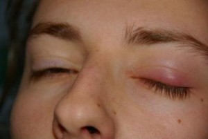 Zápal pod viečkom. Príčiny blefaritídy horného očného viečka. Zrážky v horných a dolných viečkach