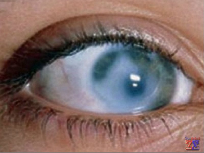 Каламутні очі у людини - які причини помутніння. З чим буває пов'язано помутніння рогівки