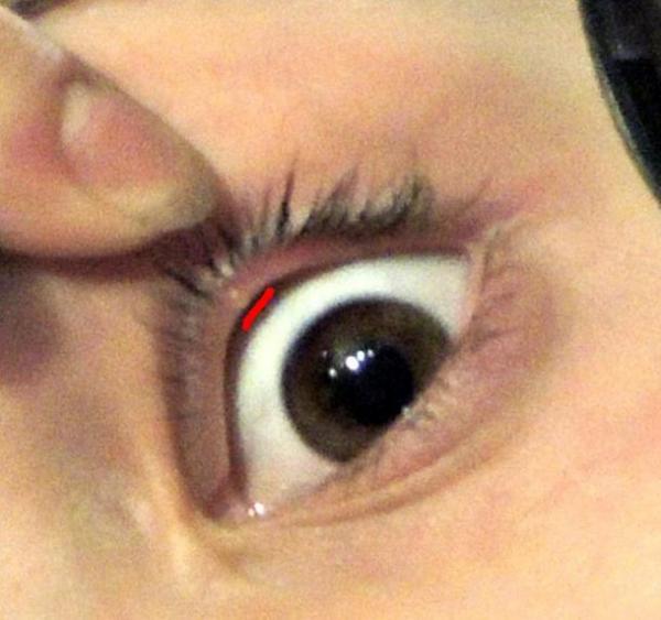 Kirpik altındaki gözün üstündeki şeffaf top. Gözdeki veya altındaki kabarcıkların etkili şekilde yok edilmesi