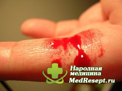 Hemofília je liečená. Zjavenie hemofílie u žien. Špeciálne metódy výskumu