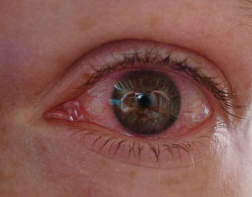 hipertenzija bolne oči