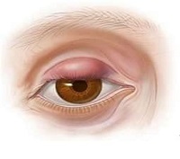 Mám červené očné viečka. Veľké očné očné viečka. Aké ochorenia spôsobujú bolesť očných viečok