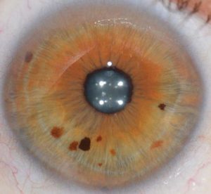 Nerovnomerné dúhovky. Definícia ochorenia na ľudskej očnej dúhovke. Homeopatické ošetrenie bodov na dúhovke