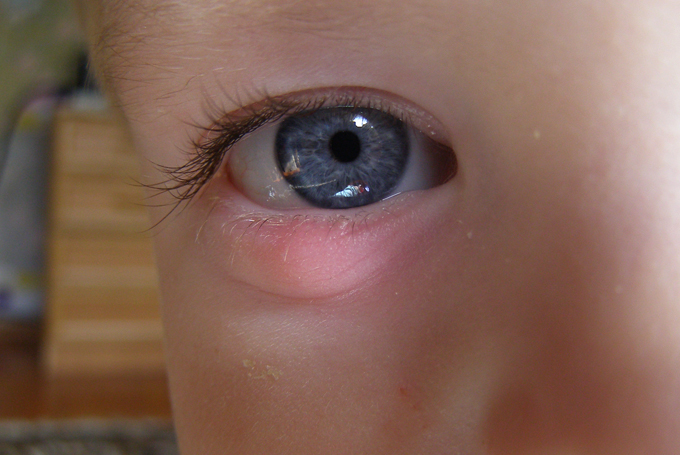 Yeni doğmuş bir bebeğin üst göz kapağındaki kırmızı nokta. Bir çocukta göz kapaklarının kızarıklığı: endişelenmeye değer mi