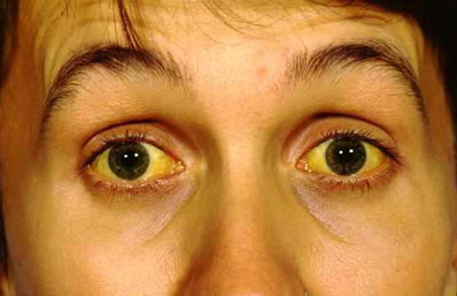 زرد اطراف چشم چیست؟ کبودی زیر چشم: از کجا آمده، و چگونه از آنها خلاص شویم - کبودی زرد
