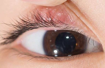 Prečo oko bolí pod horným viečkom? Príčiny bolesti pri blikaní. Demodekóza: príčiny, príznaky a liečba