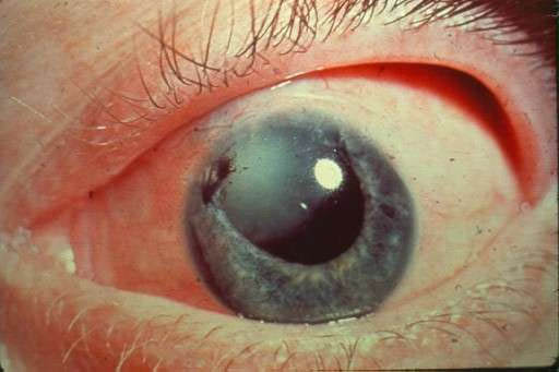 MKB'ye göre gözdeki yabancı cisim 10. Gözdeki yabancı bir cisim hissi - nedir?