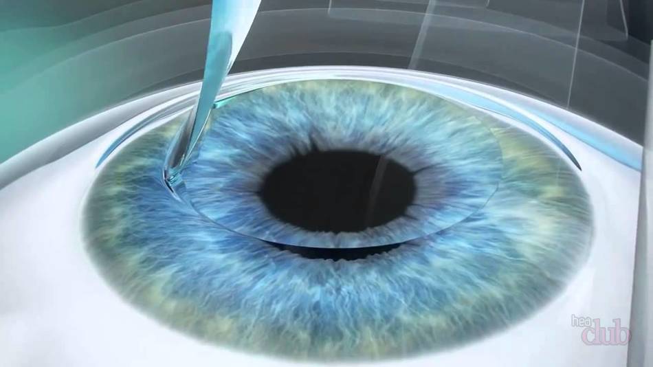 بینایی و فعالیت بدنی عواقب احتمالی، عوارض بعد از اصلاح دید. چقدر توانبخشی، بهبود پس از جراحی برای اصلاح دید؟