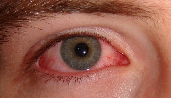 Gözün iç göz kapağının iltihabı. Bir çocuğun gözlerinin iltihabı. Blefarit belirtileri ve tedavisi