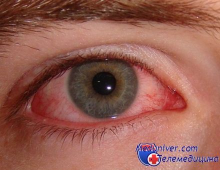 لکه خونی روی سفید چشم. در صورت بروز لکه های سیاه یا نقاط در چشم چه باید کرد