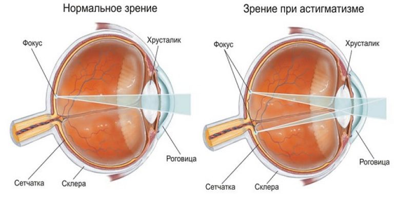 Bolalarda astigmatizm - diagnostika, tuzatish va davolash. Bolalarda astigmatizm. Natijalar, alomatlar, davolash va oldini olish.
