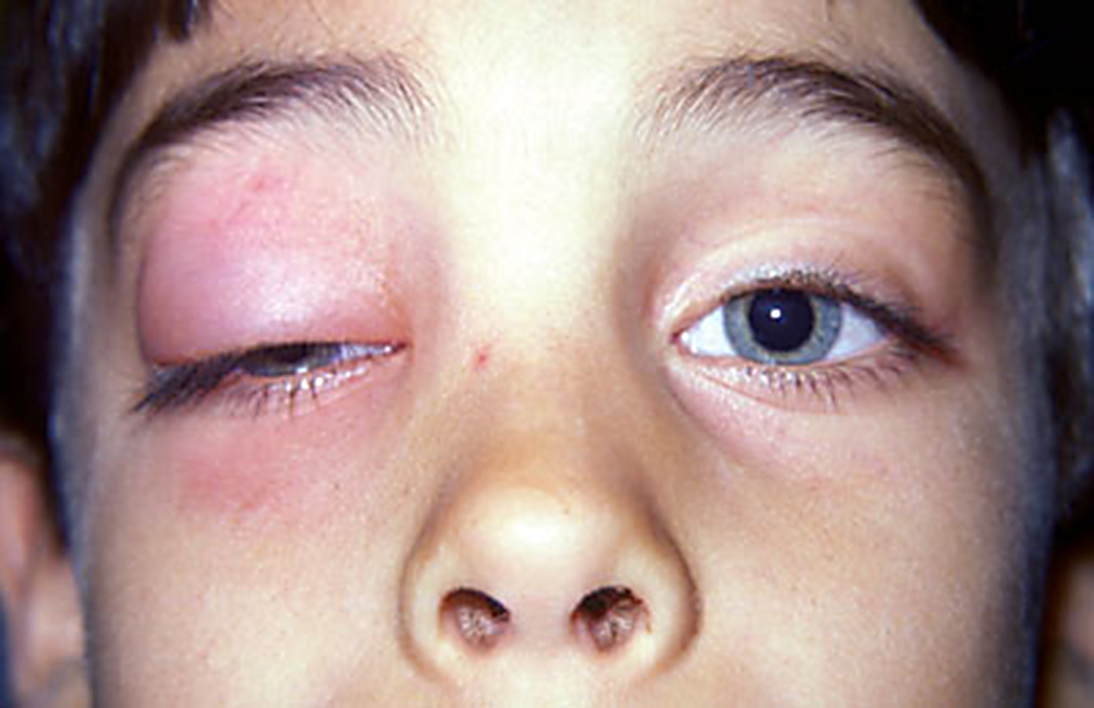 چگونگی درمان چالیزون در پماد چشم چشم، پلک ها و داروهای قومی. علائم Chalazion علائم مشخصی است. فشرده شدن با اسید بوریک