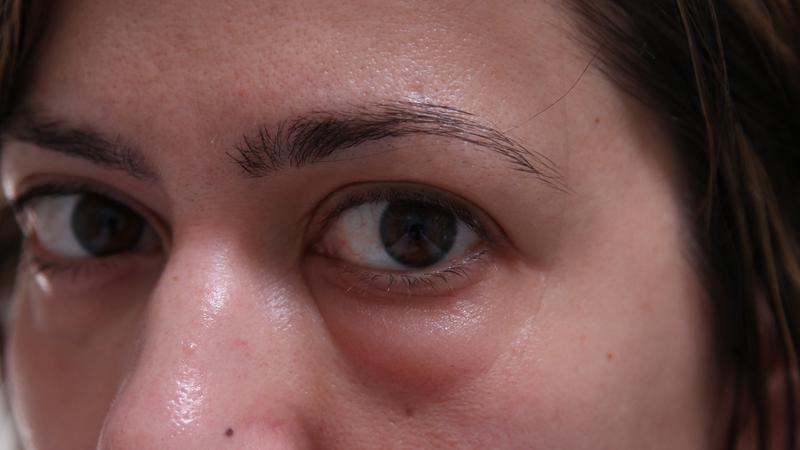 پلک ها متورم شده اند که چه باید کرد. چرا پلک ها روی و زیر چشم ورم می کنند؟ علل و درمان در خانه