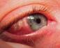 اگر چشم شما صدمه دیده باشد چه باید بکند: درمان سنتی