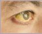 Zhovtizna pid ochima: razlozi za okrivljavanje te posebnosti